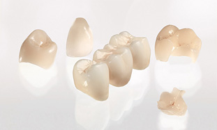 CEREC -ukážky keramických náhrad zubov
